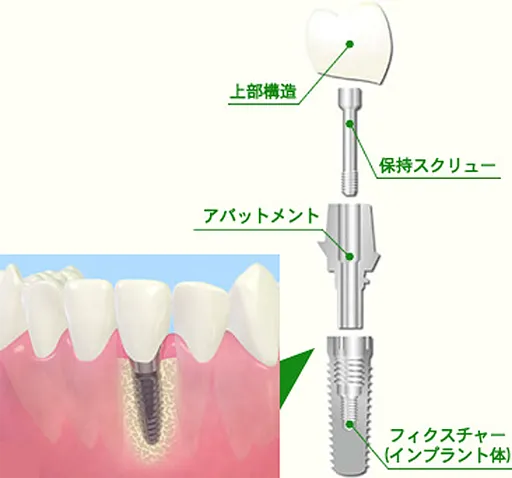 インプラント